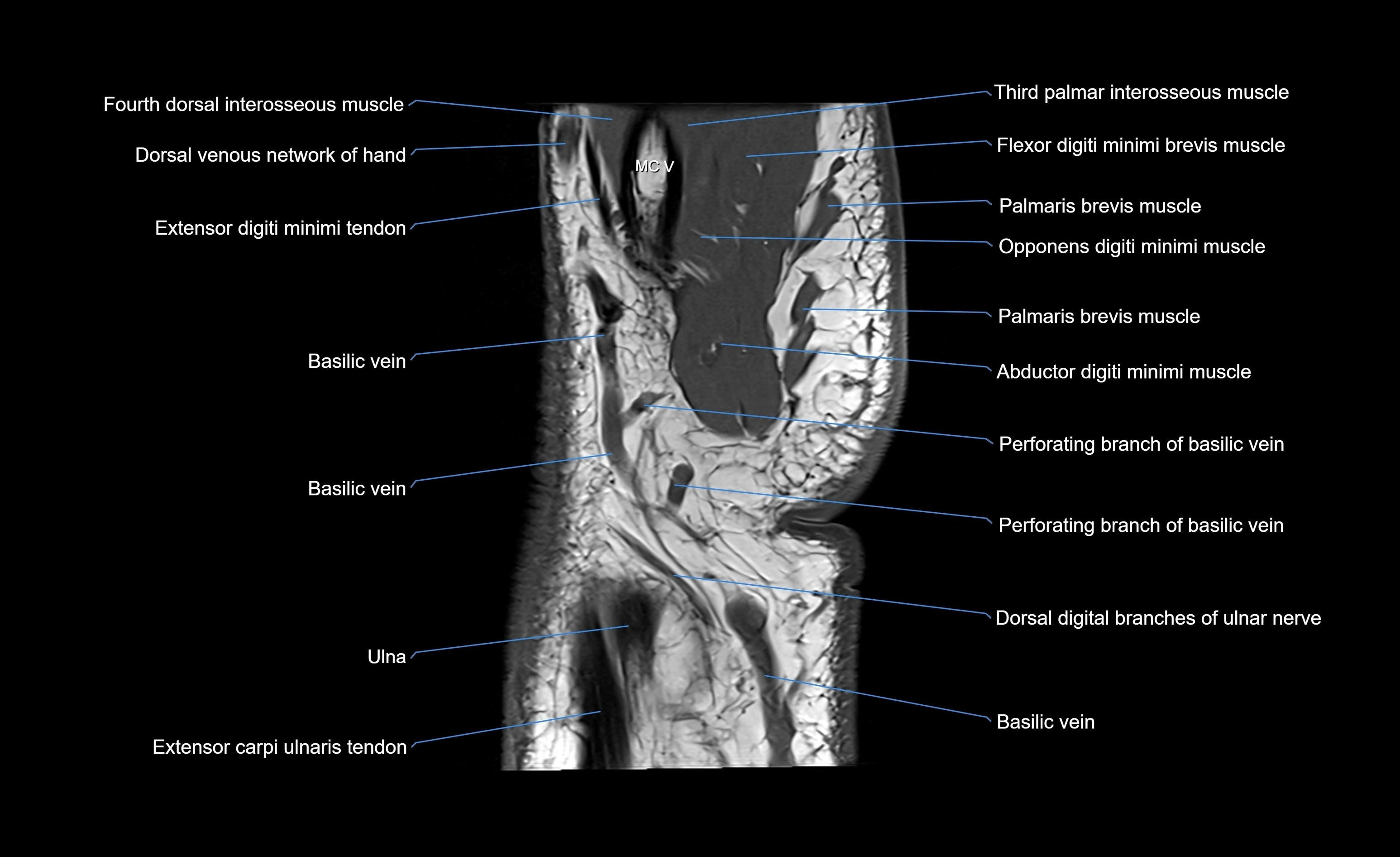 MRI wrist sagittal cross sectional anatomy 3T  radiology  image-img-00001-00024.webp